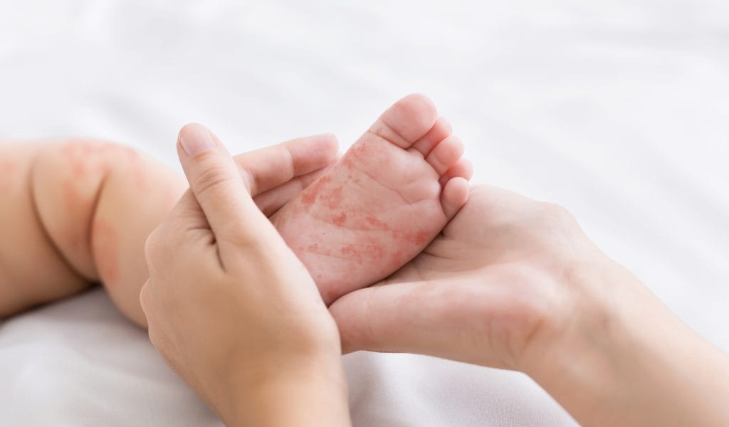 pantangan penyakit campak pada anak