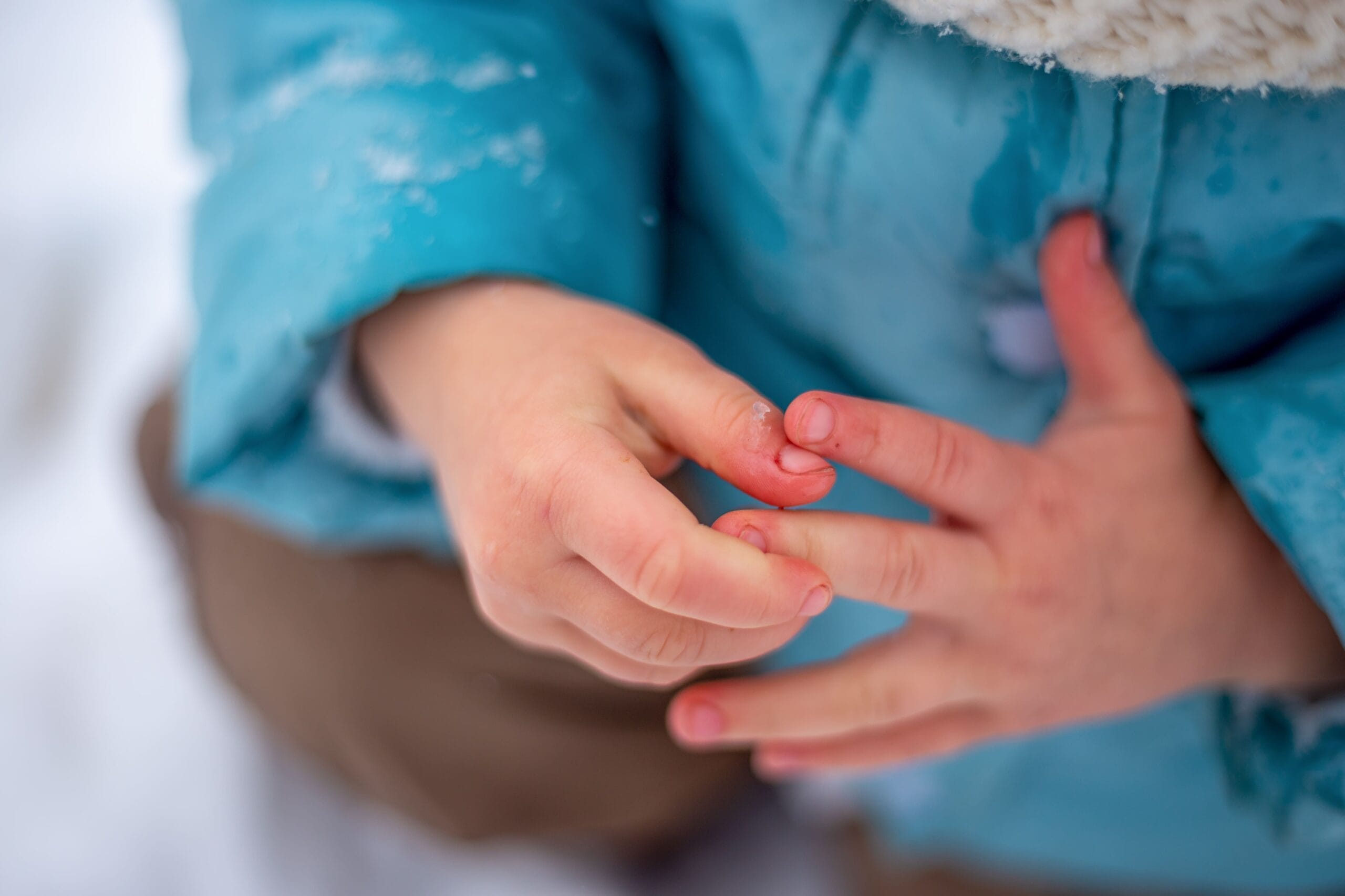 frostbite adalah