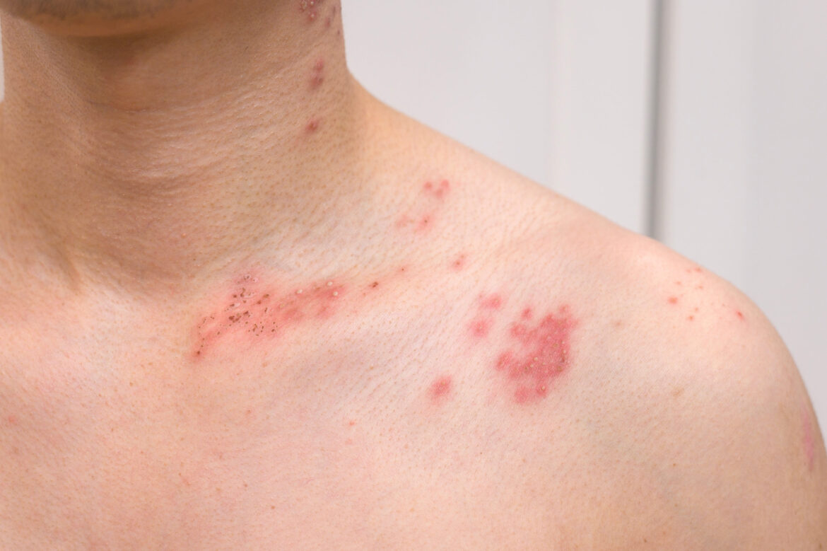 herpes zoster adalah