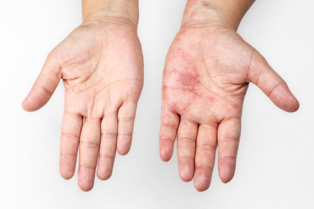 Herpes adalah
