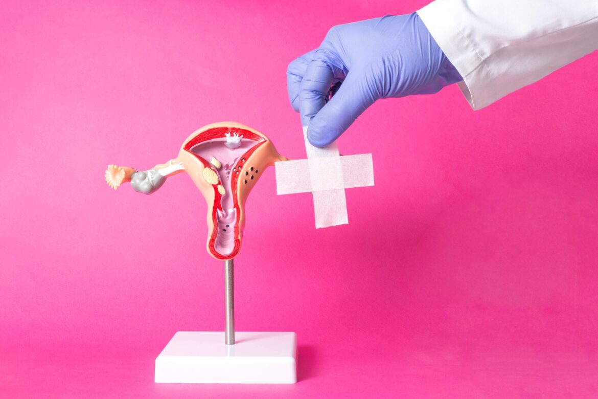 Prolaps uteri