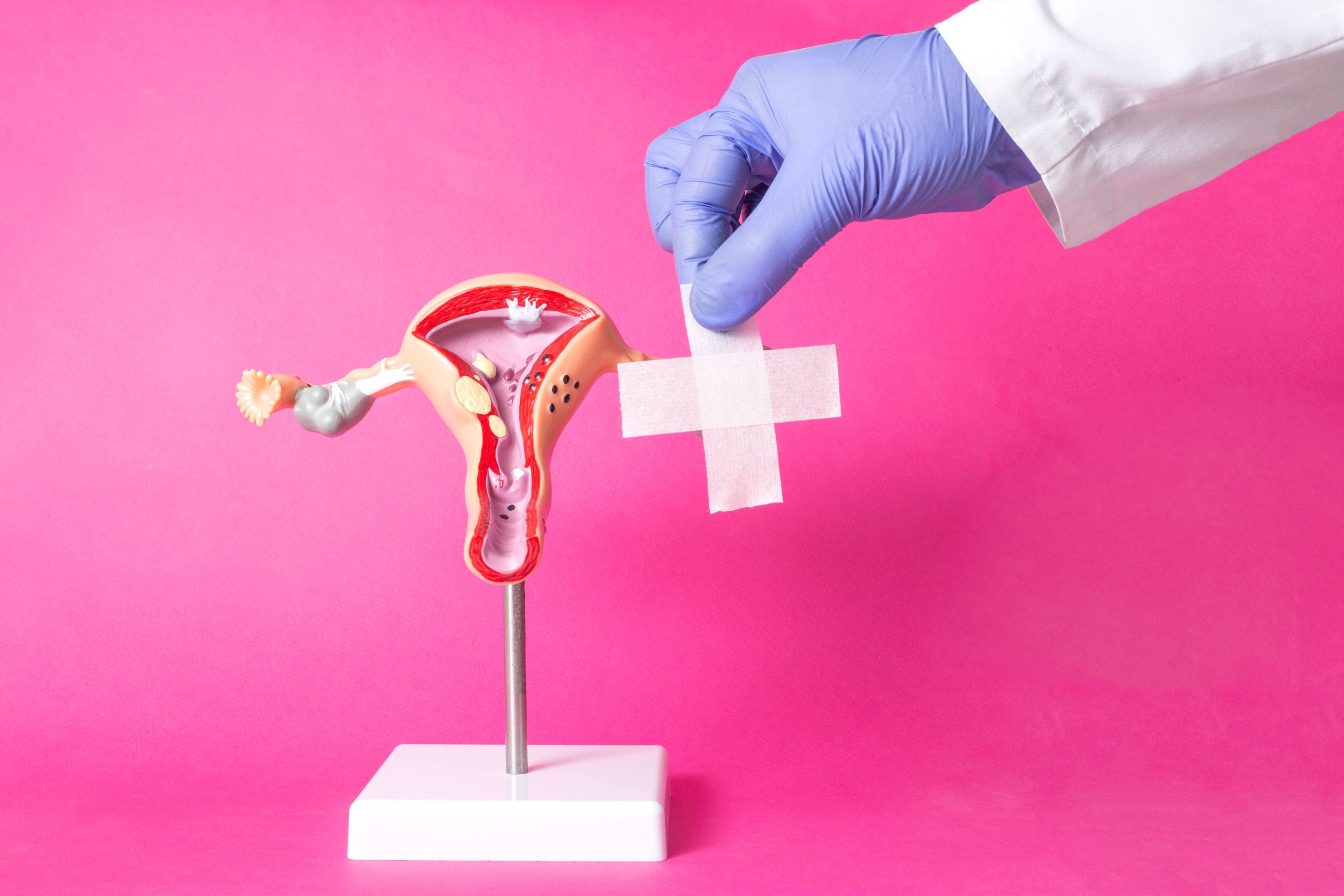 Prolaps uteri